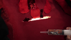 Hemophilia